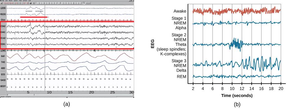 Chart A is a polysonograph with the period of rapid eye movement (REM) highlighted. Chart b shows brainwaves at various stages of sleep, with the “awake” stage highlighted to show its similarity to the wave pattern of “REM” in chart A.