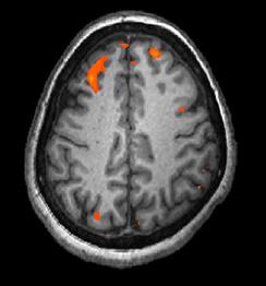 A brain scan shows brain tissue in gray with some small areas highlighted red.