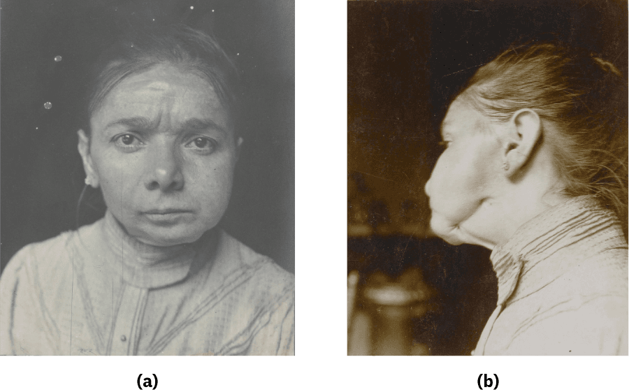 Photograph a shows a woman staring directly into the camera. A large portion of her lower jaw is missing. Photograph b shows the same woman from the side and provides another view of her abnormally shaped jaw.