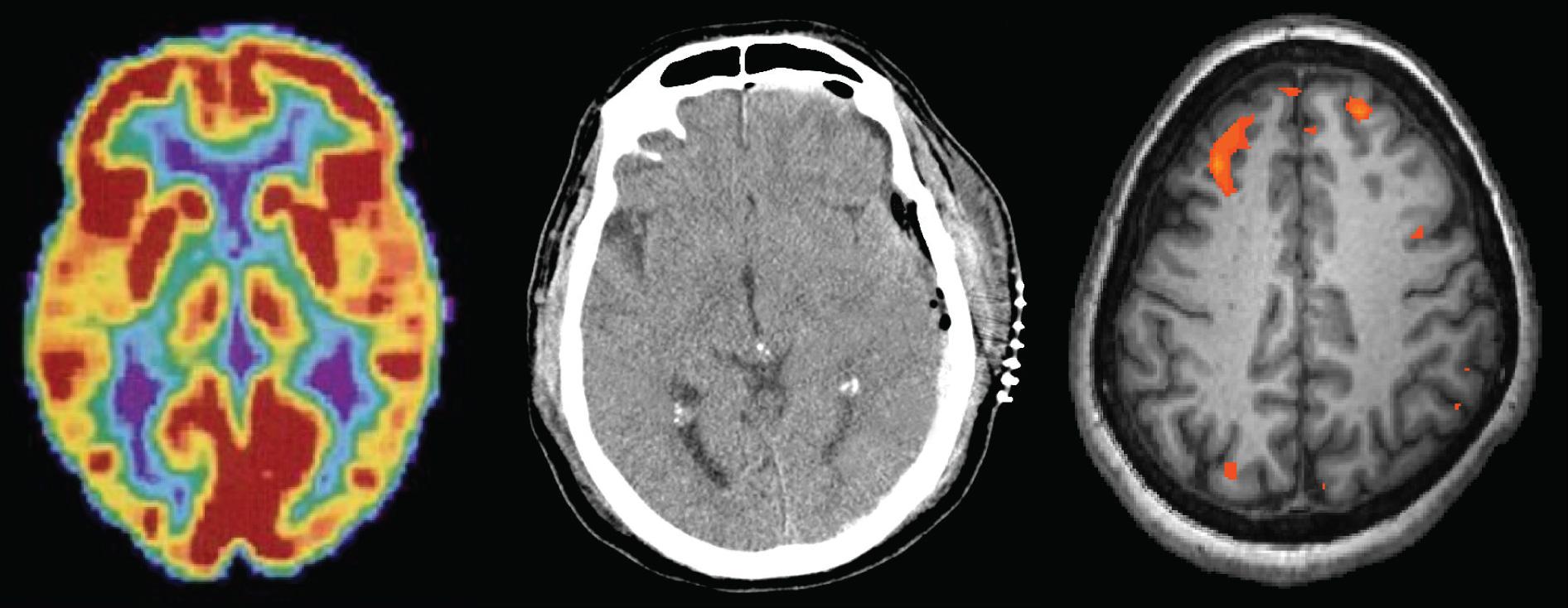 Three brain-imaging scans are shown.